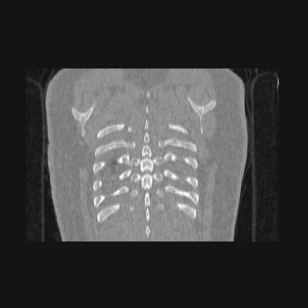 File:Bronchial atresia (Radiopaedia 60685-68439 Coronal lung window 5).jpg