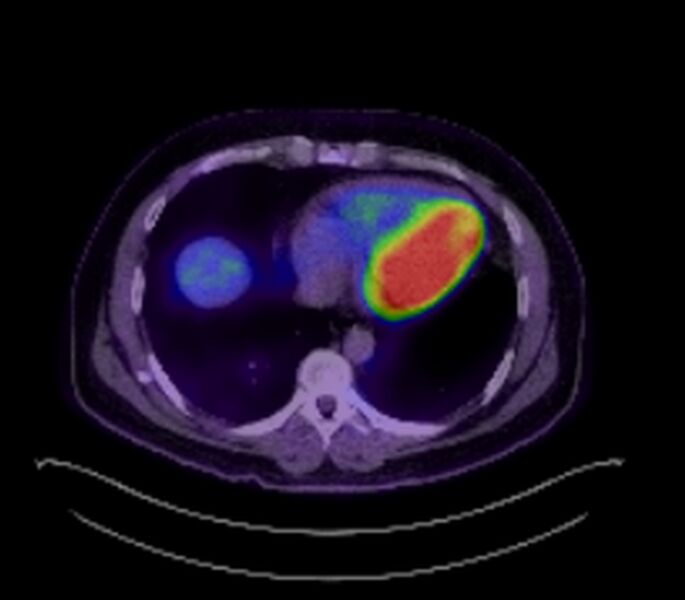 File:Bronchial carcinoid tumor (Radiopaedia 67377-76766 18FDG-PET-CT 34).jpg