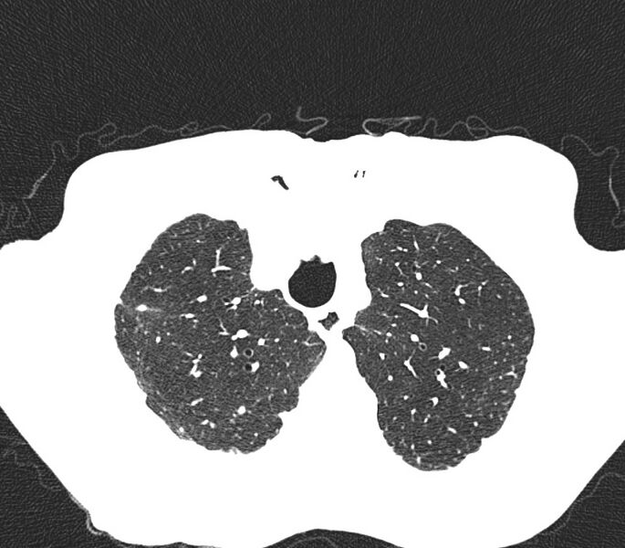 File:Bronchiolitis (Radiopaedia 24616-24887 Axial lung window 6).jpg