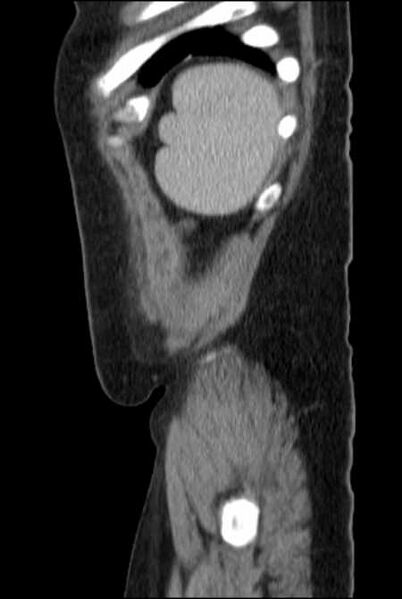 File:Brown tumors compressing the spinal cord (Radiopaedia 68442-77988 F 51).jpg