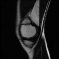 Bucket handle tear - lateral meniscus (Radiopaedia 72124-82634 Sagittal T2 14).jpg