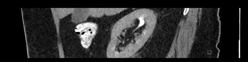 Buried bumper syndrome - gastrostomy tube (Radiopaedia 63843-72575 Sagittal Inject 88).jpg