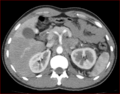 Burned-out testicular choriocarcinoma (Radiopaedia 32822-34040 B 4).PNG