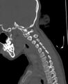 Butterfly vertebra (Radiopaedia 77903-90209 Sagittal bone window 70).jpg