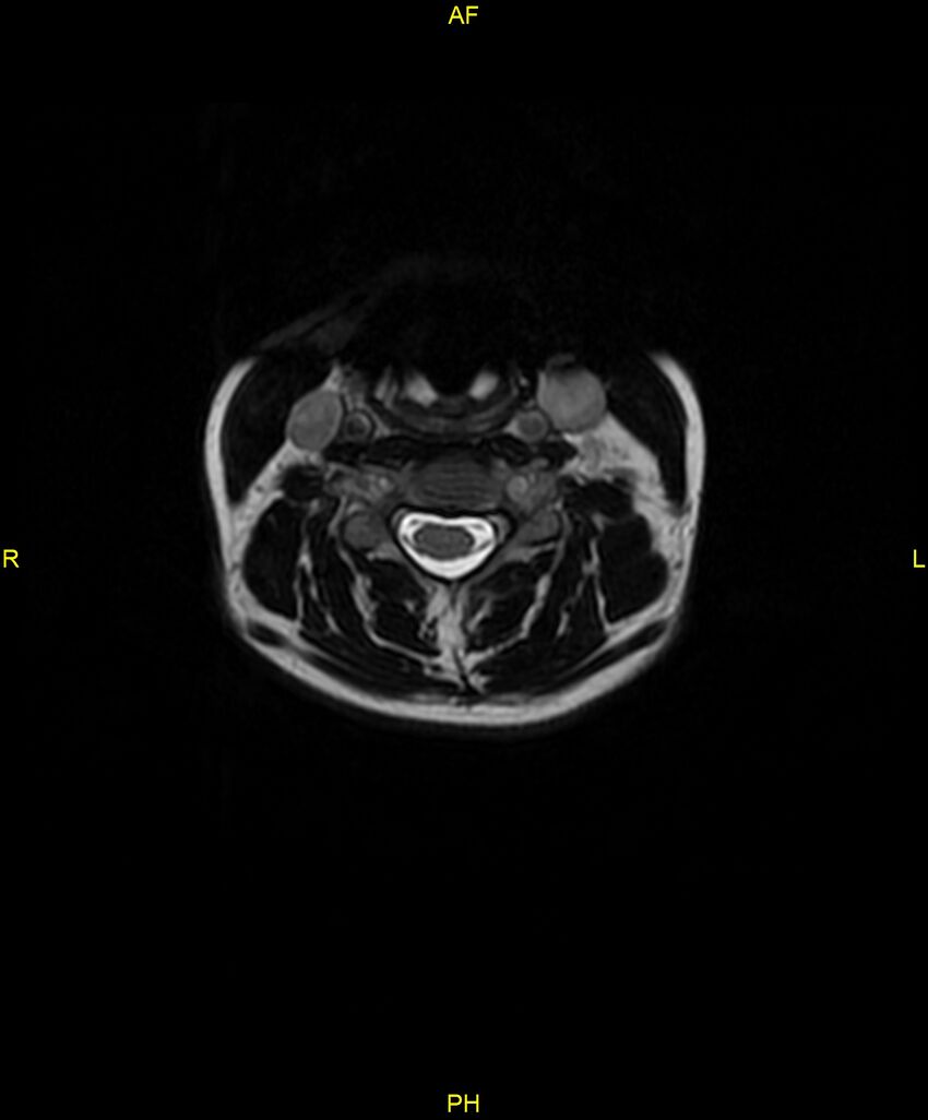C5 nerve sheath tumor (Radiopaedia 85777-101596 Axial T2 28).jpg