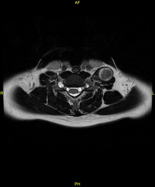 File:C5 nerve sheath tumor (Radiopaedia 85777-101596 Axial T2 54).jpg