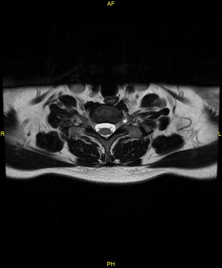 C5 nerve sheath tumor (Radiopaedia 85777-101596 Axial T2 68).jpg
