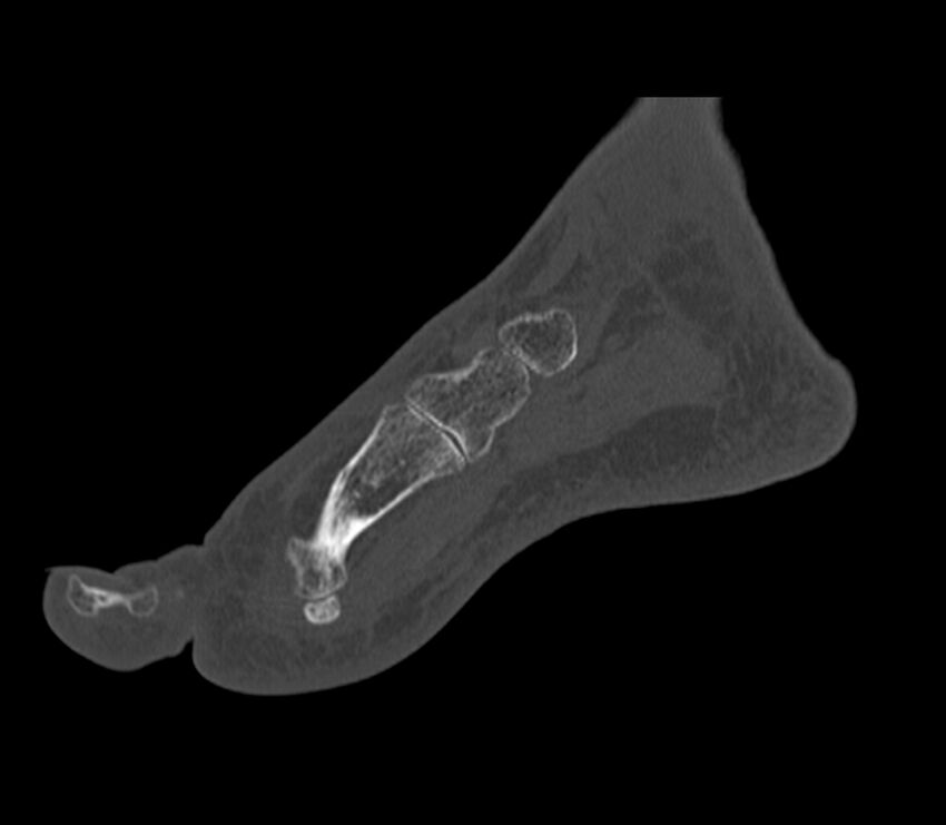 Calcaneal tuberosity avulsion fracture (Radiopaedia 22649-22668 Sagittal bone window 40).jpg