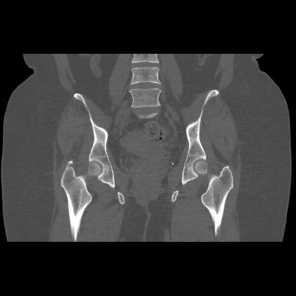 File:Calcific tendinitis of the gluteus medius muscle (Radiopaedia 66998-76318 Coronal bone window 33).jpg