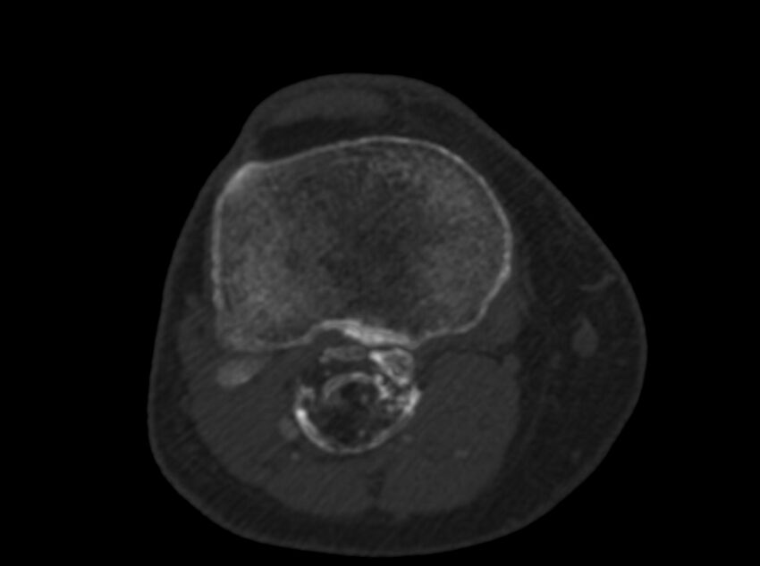 Calcified hematoma - popliteal fossa (Radiopaedia 63938-72763 C 50).jpg