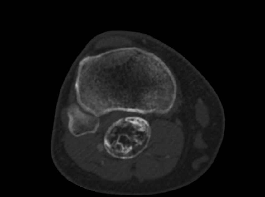 Calcified hematoma - popliteal fossa (Radiopaedia 63938-72763 C 59).jpg