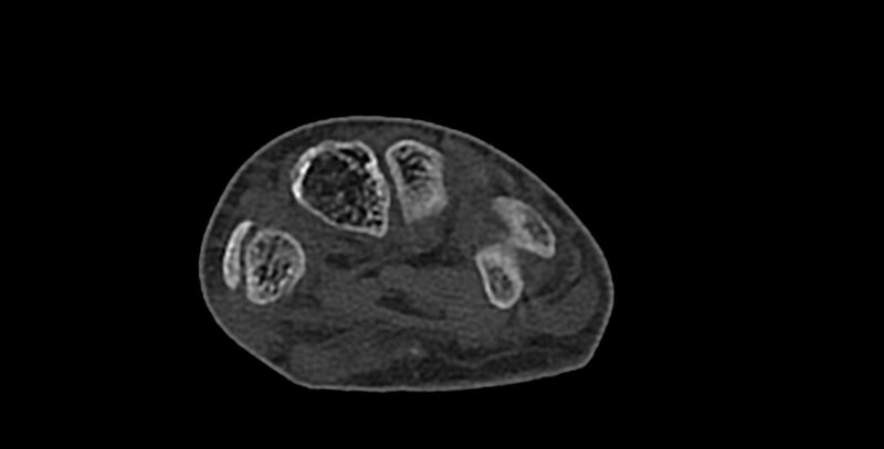 File:Calcifying aponeurotic fibroma (Radiopaedia 88423-105064 Axial bone window 118).jpg