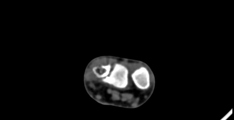 File:Calcifying aponeurotic fibroma (Radiopaedia 88423-105064 B 23).jpg