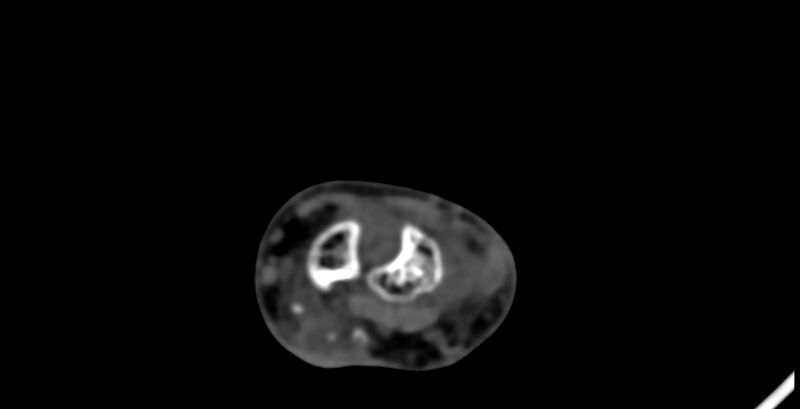 File:Calcifying aponeurotic fibroma (Radiopaedia 88423-105064 B 58).jpg
