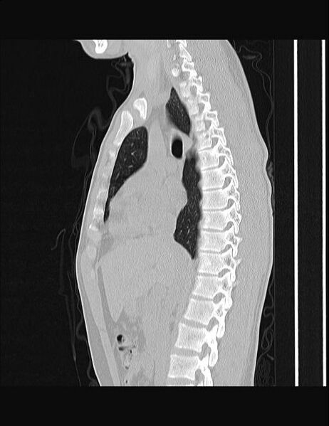 File:Calcifying pulmonary metastases (Radiopaedia 33359-34396 Sagittal lung window 39).jpg