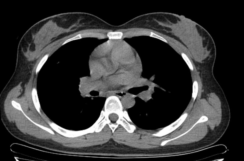 File:Cannonball metastases - uterine choriocarcinoma (Radiopaedia 70137-80173 Axial non-contrast 50).jpg