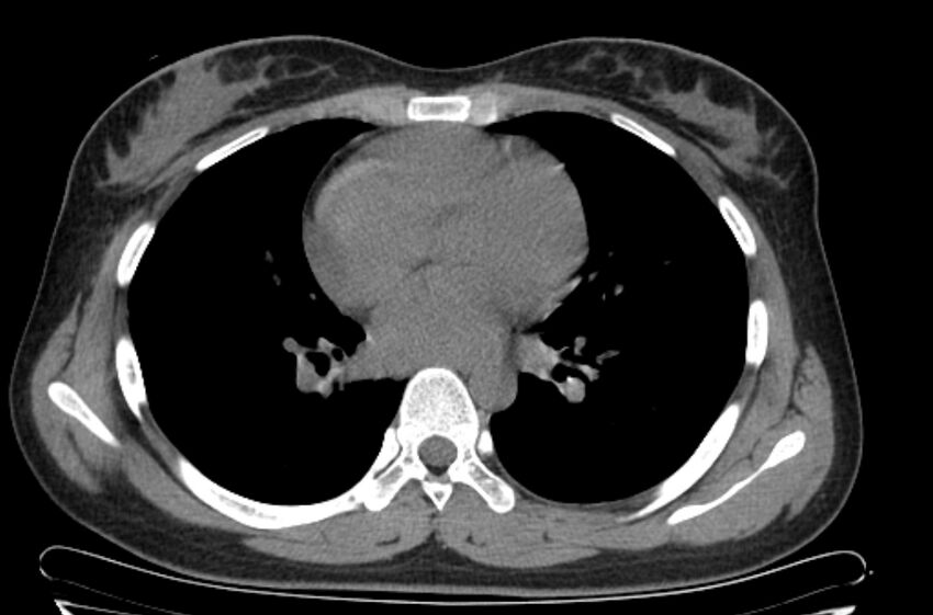 Cannonball metastases - uterine choriocarcinoma (Radiopaedia 70137-80173 Axial non-contrast 65).jpg