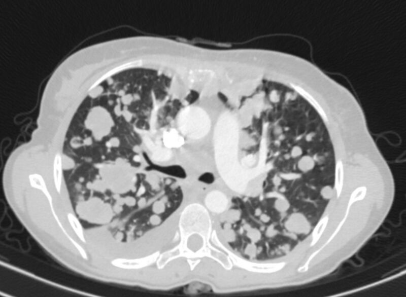 File:Cannonball metastases from breast cancer (Radiopaedia 91024-108569 Axial lung window 36).jpg