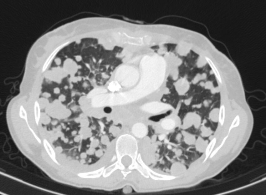 Cannonball metastases from breast cancer (Radiopaedia 91024-108569 Axial lung window 45).jpg