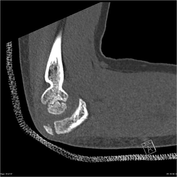 File:Capitellum fracture (Radiopaedia 23352-23426 Sagittal bone window 39).jpg