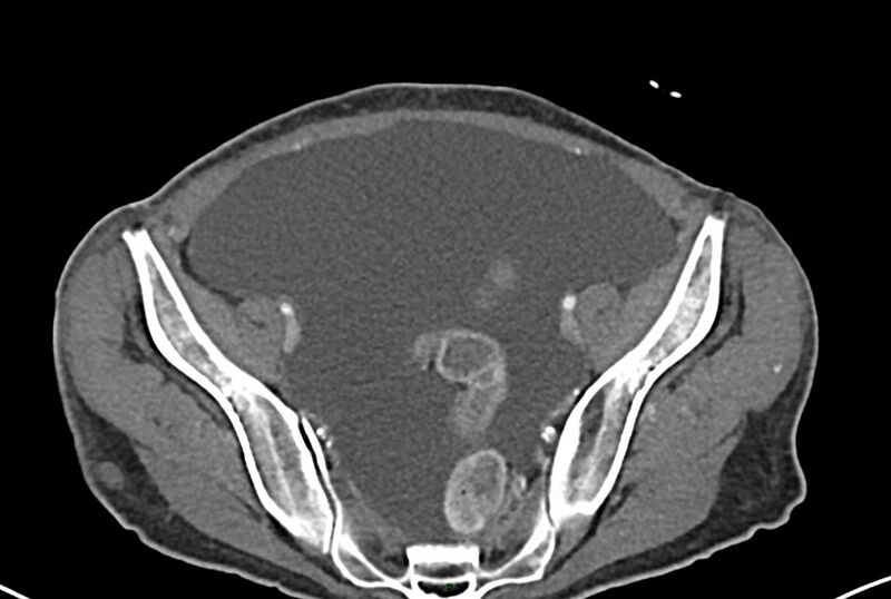 File:Carcinoid mesenteric tumor complicated by chylous ascites (Radiopaedia 76312-87953 A 62).jpg