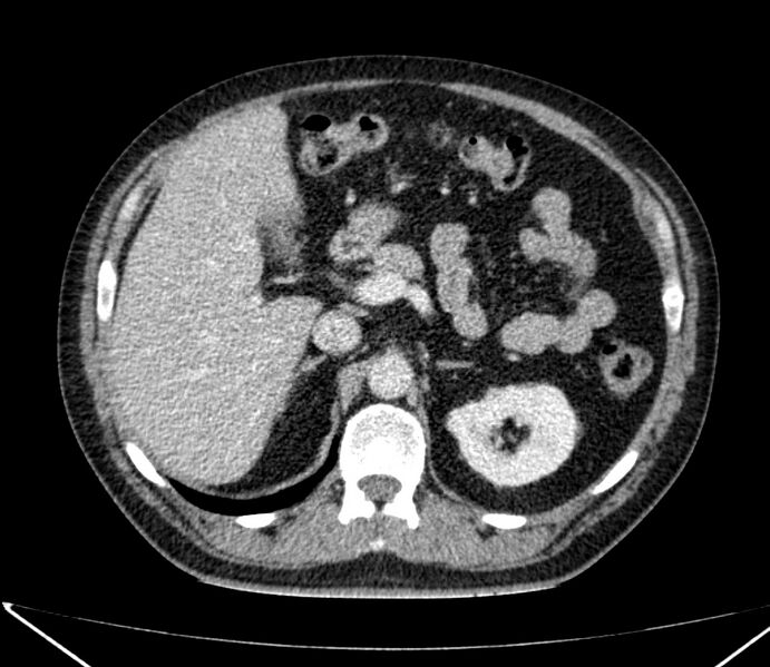 File:Carcinoid tumor with hepatic metastases (Radiopaedia 22651-22670 C 40).jpg