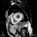 Cardiac amyloidosis (Radiopaedia 62017-70102 I 1).jpg