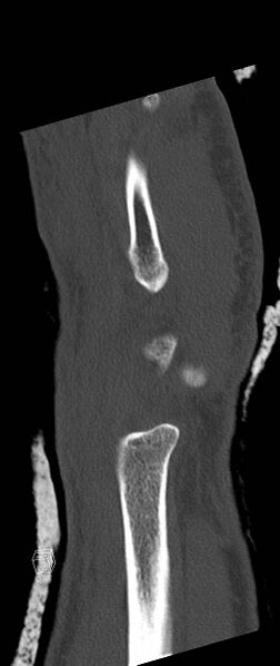 File:Carpal fractures (smart watch impaction) (Radiopaedia 55844-62430 Sagittal bone window 6).jpg