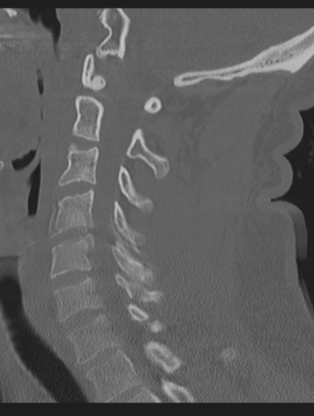 File:Cavernoma of cervical cord (Radiopaedia 50838-56346 Sagittal bone window 46).png