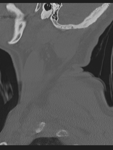 File:Cavernoma of cervical cord (Radiopaedia 50838-56346 Sagittal bone window 7).png