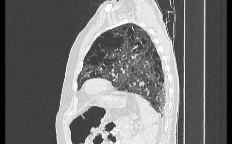 File:Cavitating bronchogenic carcinoma (Radiopaedia 44489-48162 Sagittal lung window 51).jpg