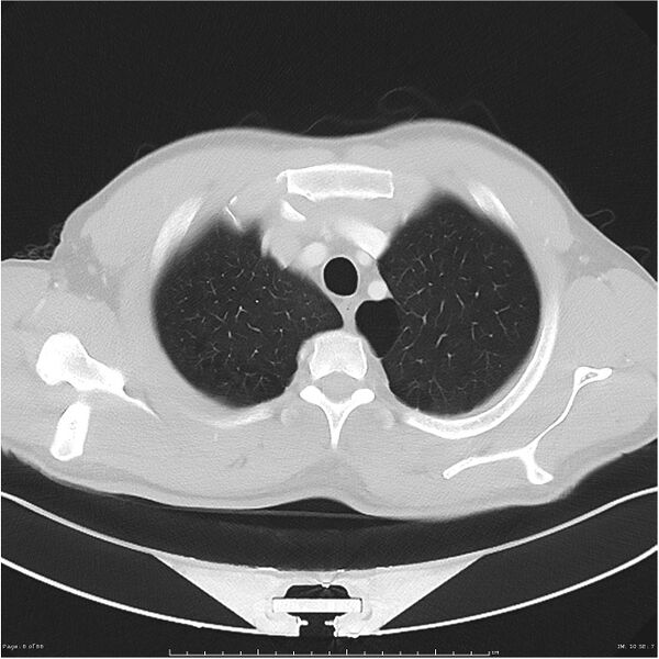 File:Cavitating lung cancer (Radiopaedia 25796-25945 Axial lung window 6).jpg