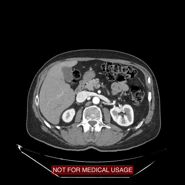 File:Celiac trunk variant anatomy - gastrohepatic trunk and splenic artery (Radiopaedia 38815-40995 A 42).jpg