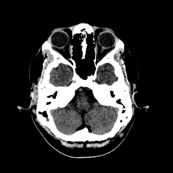 File:Central nervous system Langerhans cell histiocytosis (Radiopaedia 65728-74878 Axial non-contrast 13).jpg