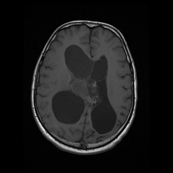 File:Central neurocytoma (Radiopaedia 67618-77021 Axial T1 16).jpg
