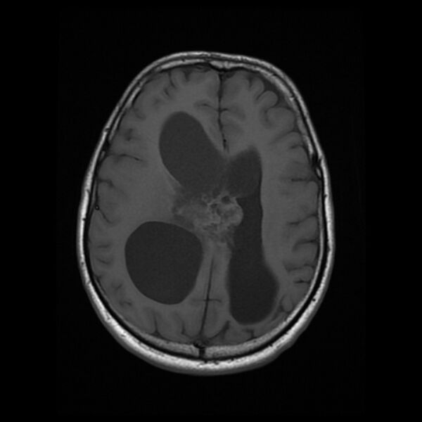 File:Central neurocytoma (Radiopaedia 67618-77021 Axial T1 17).jpg
