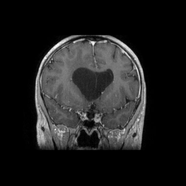 File:Central neurocytoma (Radiopaedia 67618-77021 Coronal T1 C+ 20).jpg