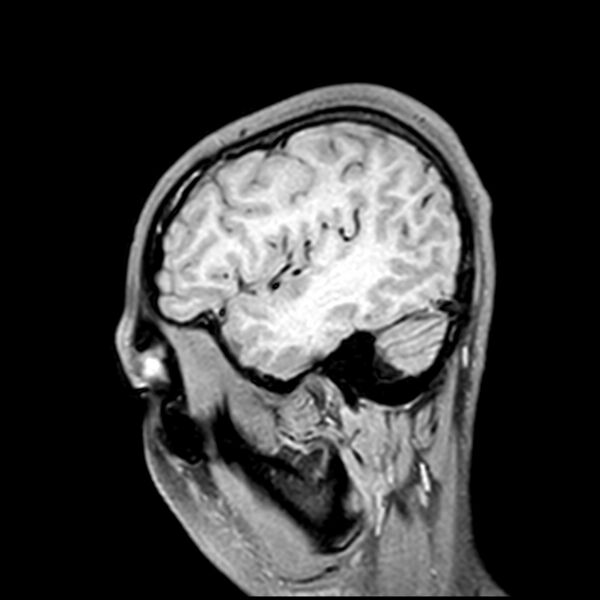 File:Central neurocytoma (Radiopaedia 79320-92380 Sagittal T1 57).jpg