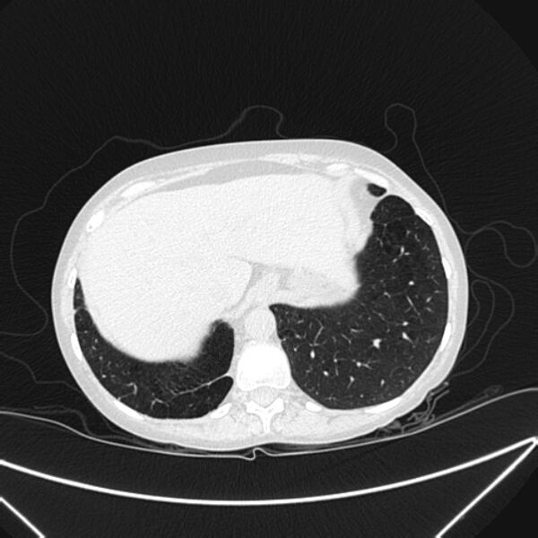 File:Centrilobular pulmonary emphysema (Radiopaedia 24495-24789 Axial lung window 81).jpg