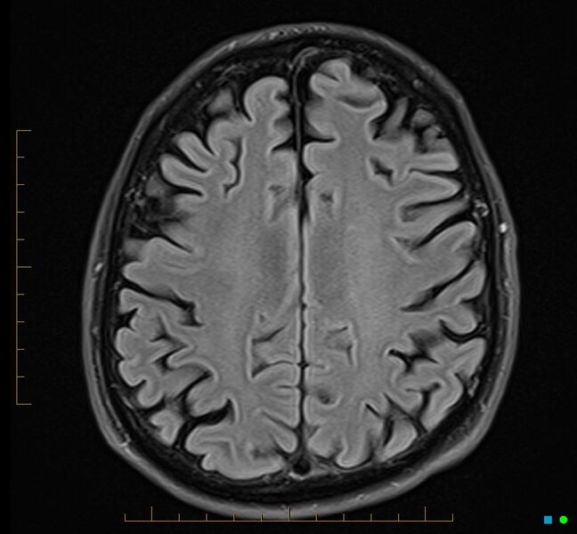 File:Cerebellar gangliocytoma (Radiopaedia 65377-74422 Axial FLAIR 28).jpg