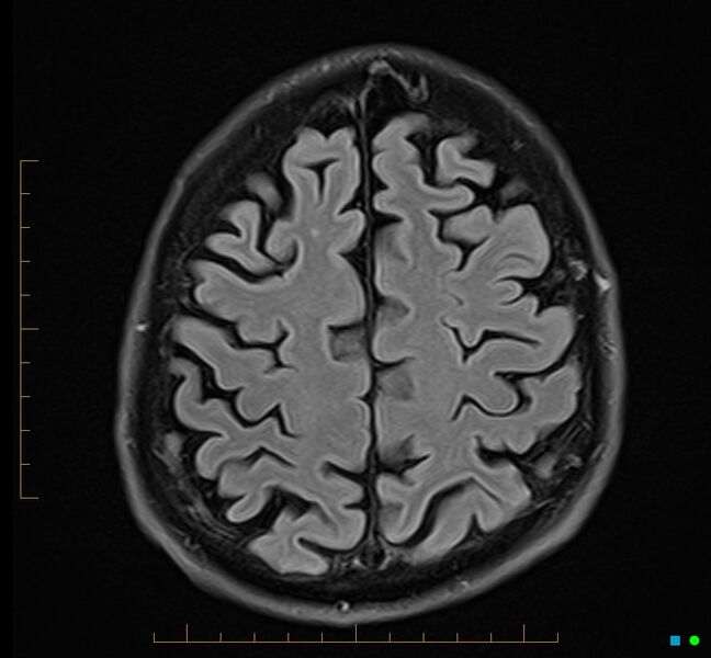 File:Cerebellar gangliocytoma (Radiopaedia 65377-74422 Axial FLAIR 31).jpg