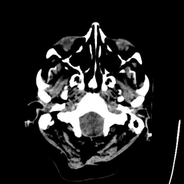 File:Cerebellar hemorrhage causing obstructive hydrocephalus (Radiopaedia 33989-35207 Axial non-contrast 4).jpg