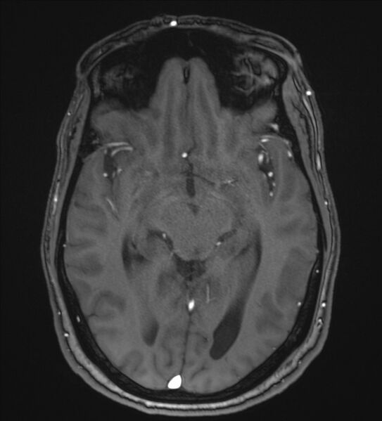 File:Cerebellopontine angle meningioma (Radiopaedia 72983-83680 Axial MRA 55).jpg