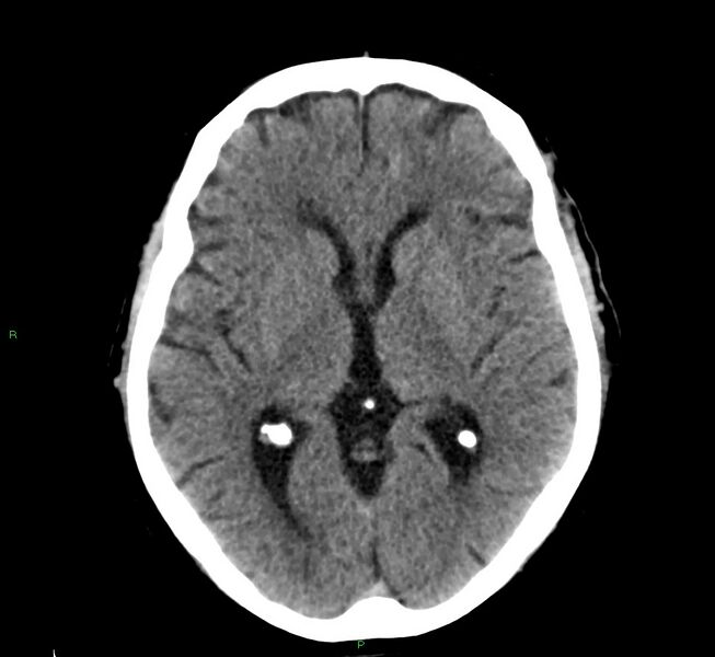 File:Cerebral amyloid angiopathy-associated lobar intracerebral hemorrhage (Radiopaedia 58376-65511 Axial non-contrast 31).jpg