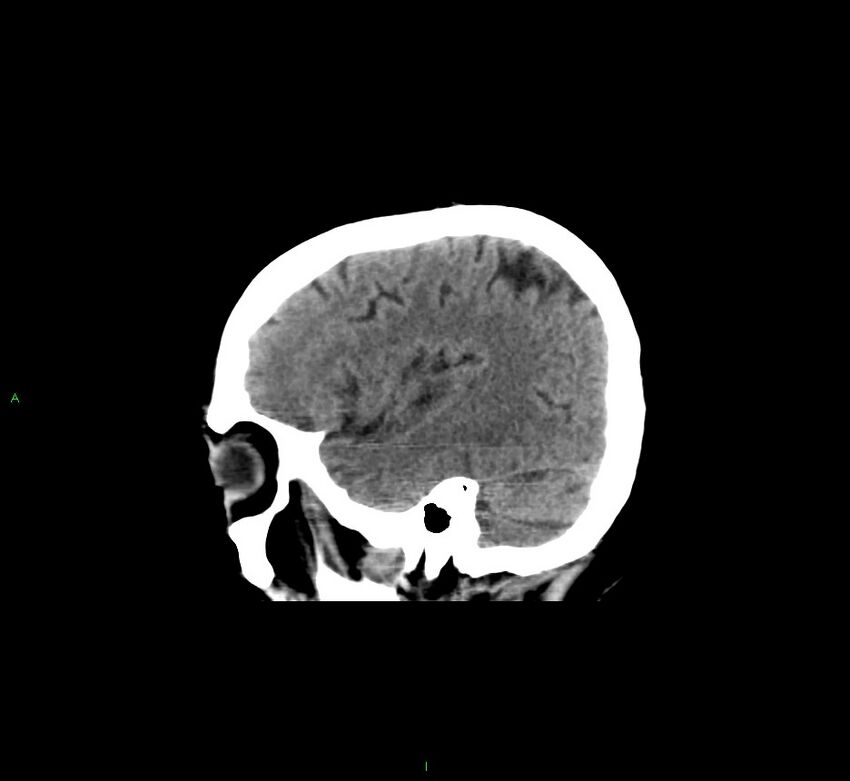 Cerebral amyloid angiopathy-associated lobar intracerebral hemorrhage (Radiopaedia 58529-65681 B 12).jpg