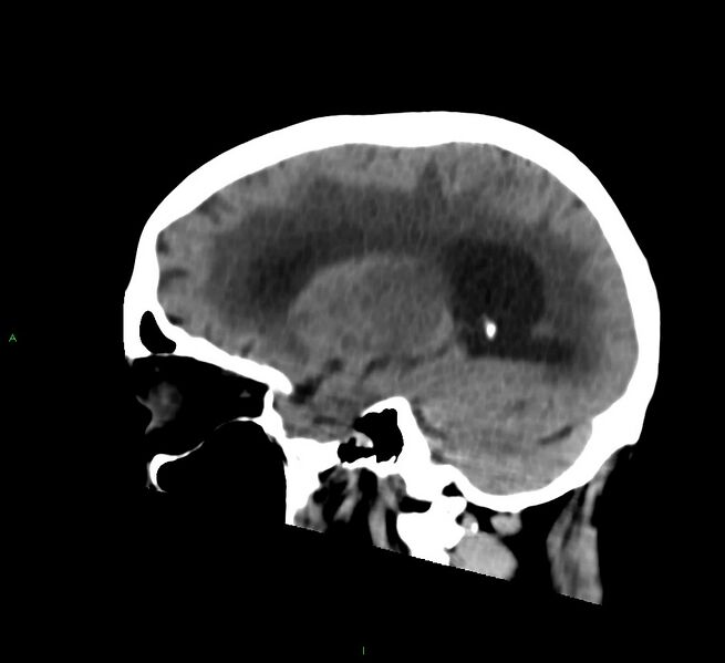 File:Cerebral amyloid angiopathy-associated lobar intracerebral hemorrhage (Radiopaedia 58530-65688 C 19).jpg