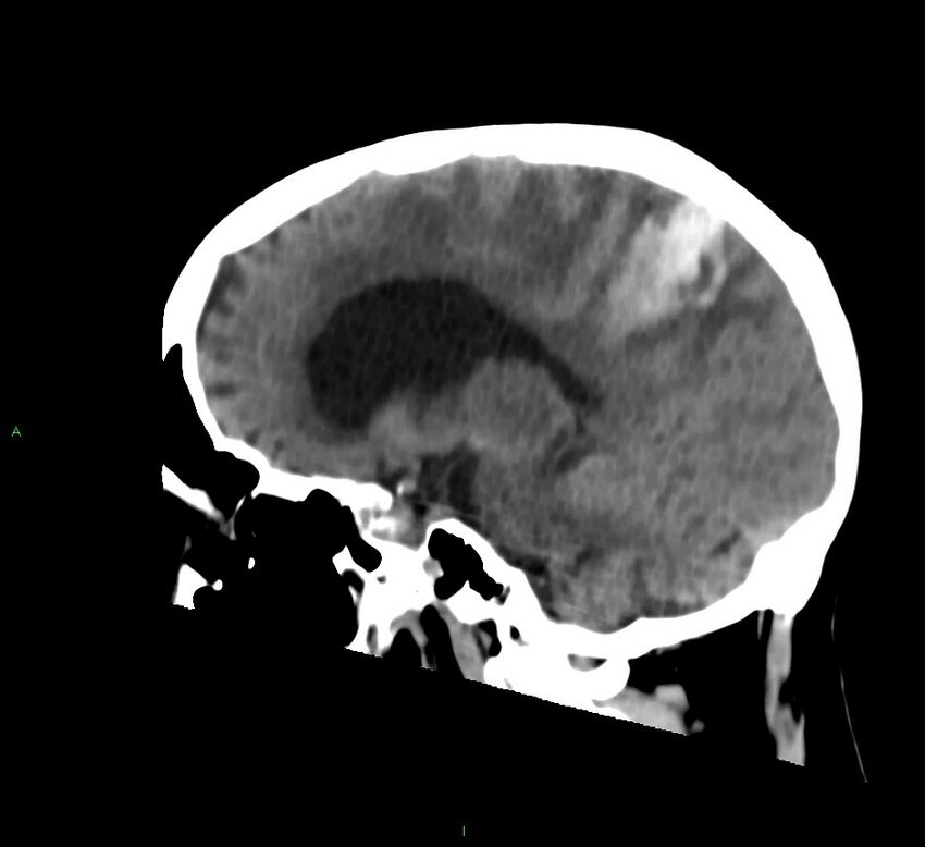Cerebral amyloid angiopathy-associated lobar intracerebral hemorrhage (Radiopaedia 58530-65688 C 32).jpg