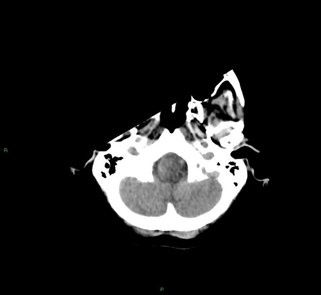 File:Cerebral amyloid angiopathy-associated lobar intracerebral hemorrhage (Radiopaedia 58754-65975 Axial non-contrast 51).jpg