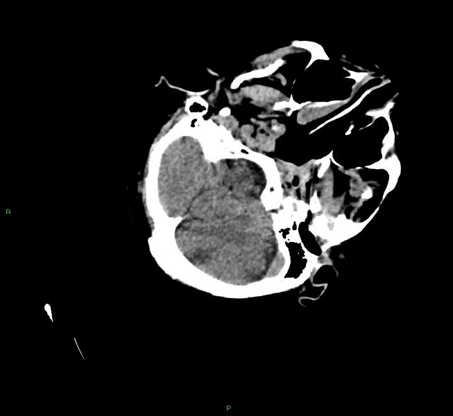 File:Cerebral amyloid angiopathy-associated lobar intracerebral hemorrhage (Radiopaedia 58757-65979 Axial non-contrast 31).jpg