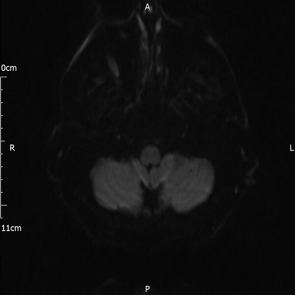 File:Cerebral amyloid angiopathy related inflammation (Radiopaedia 72772-83415 Axial DWI 27).jpg